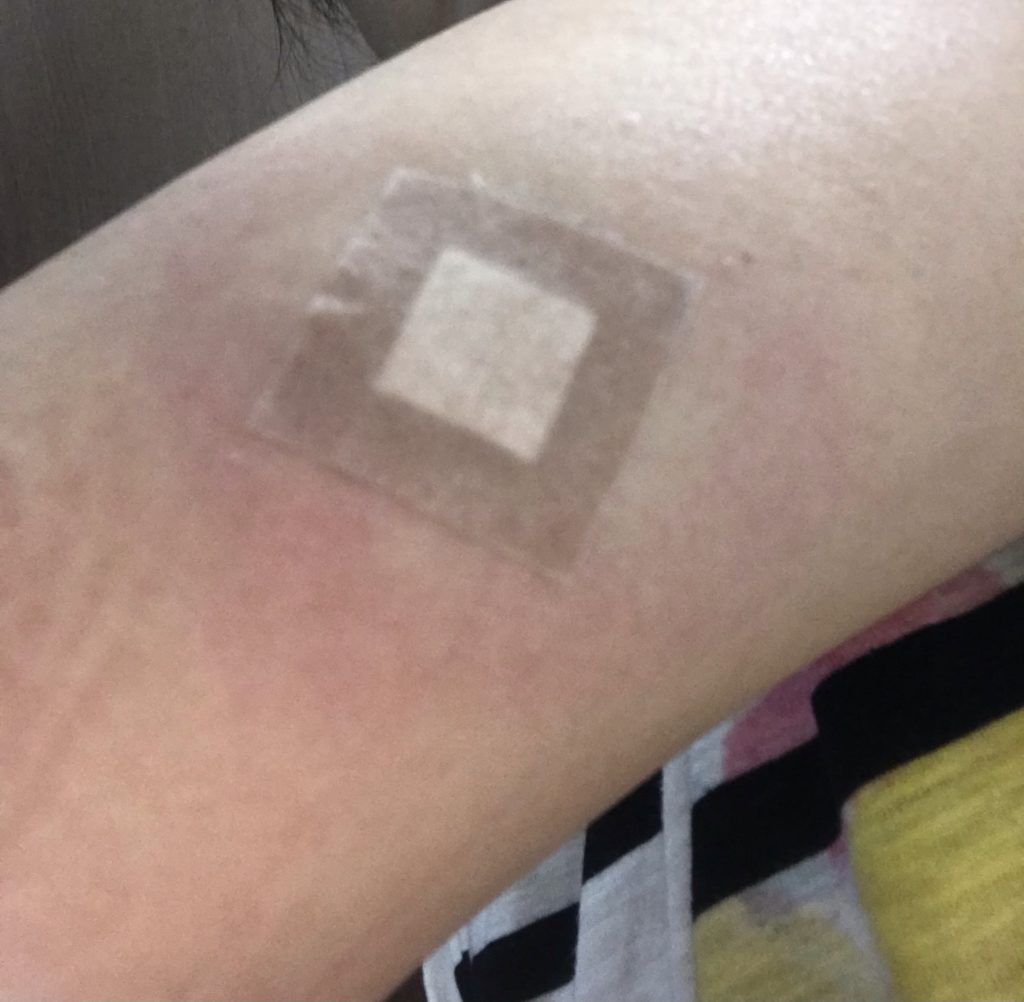 インフルエンザ ワクチン 腫れる